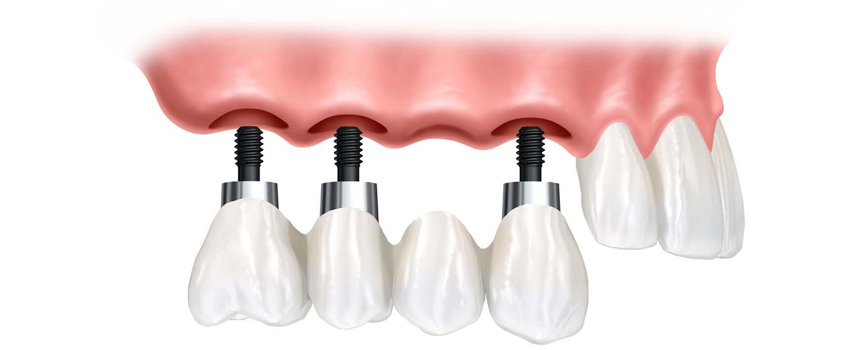 имплантация зубов одесса