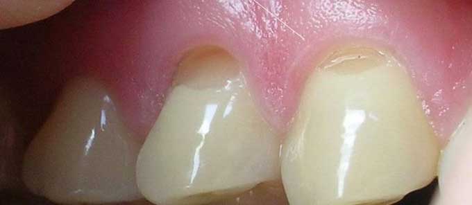Клиновидные дефекты зубов
