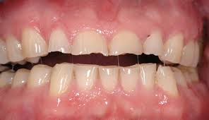 патологическая стираемость зубов